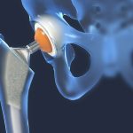 大腿骨頸部骨折後の歩行困難の原因はCRPS