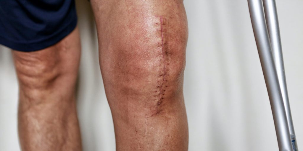 術後に膝が曲がらない本当の理由 日本オランダ徒手療法協会