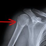 上腕骨骨折後の可動域を簡単にあげる方法